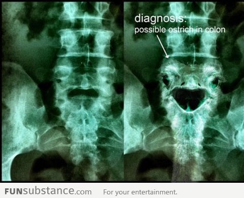 Medical diagnosis: Ostrich in colon