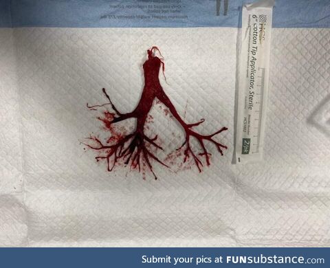 Intact blood clot that was attached to the ETT of a terminally extubated Covid patient