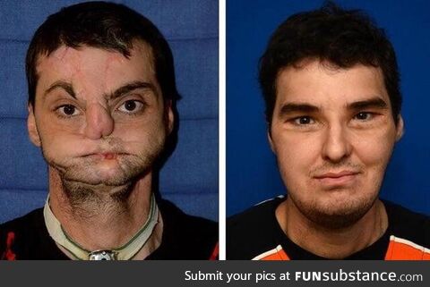 Richard Norris before and after receivingthe world’s first full face transplant