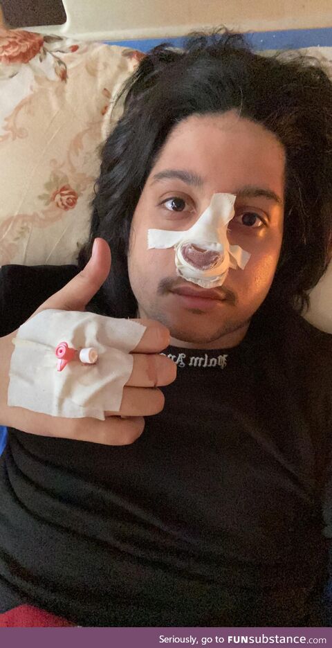 Got deviated septum surgery! Two days of hell. No breathing through nose,can’t eat and