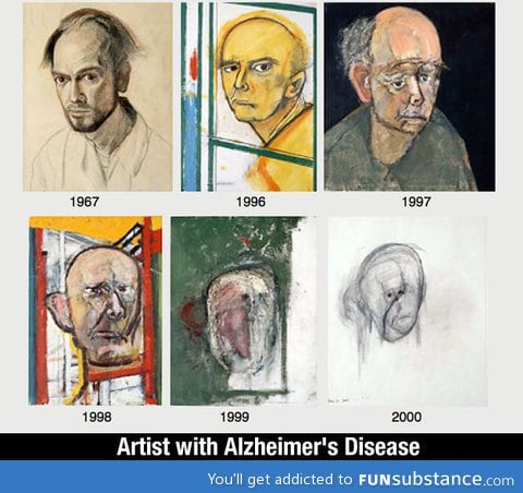 Artist with Alzheimer's deases