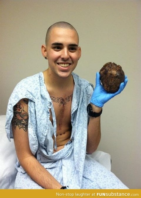 man holds his own old diseased heart after transplant